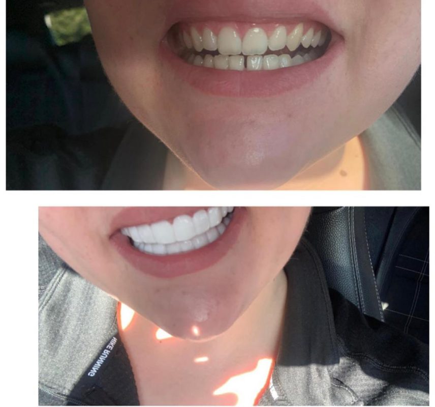 Shade Guide Clip In Veneers from Need That Smile