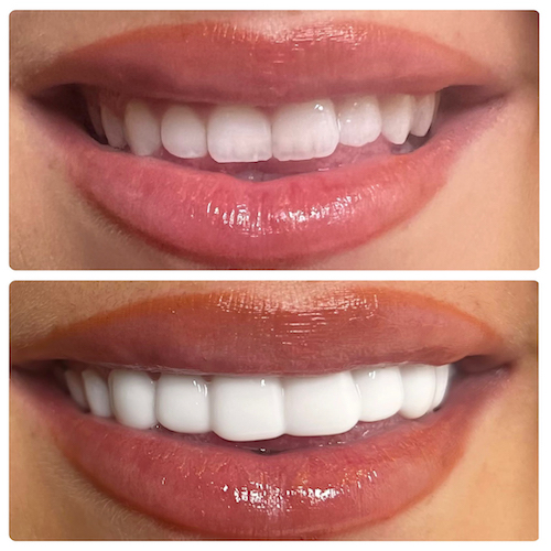 Shade Guide Clip In Veneers from Need That Smile